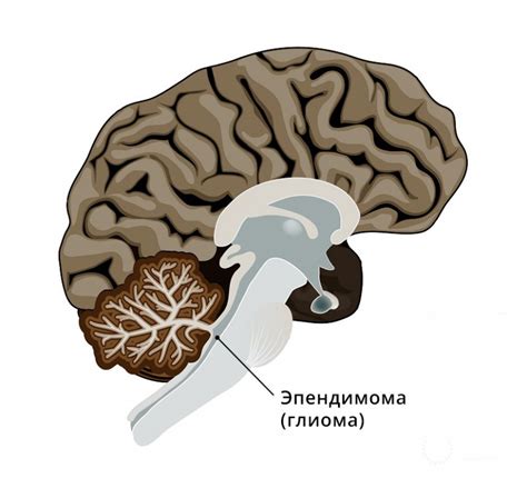 Эпендимома 4 желудочка - диагностика и лечение