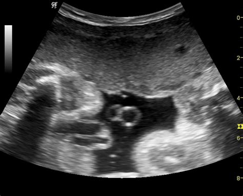 Bildergebnis für 2 vessel umbilical cord ultrasound