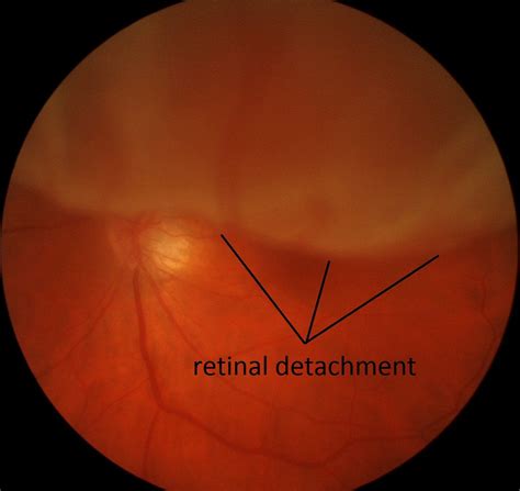 Image result for Visual Problems