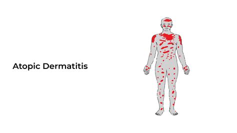 Atopic Dermatitis: Types, Causes, and Treatment ~ Healthcare City
