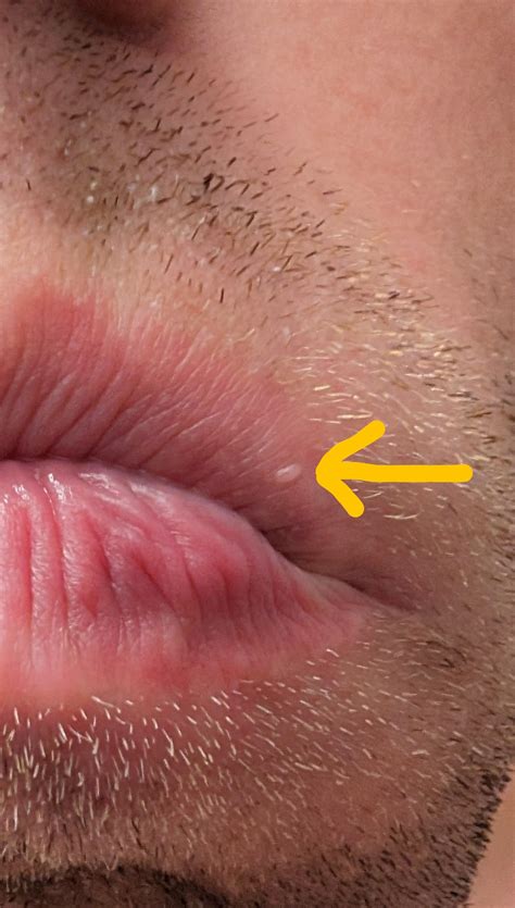 What is this bump on my lip? : r/DermatologyQuestions