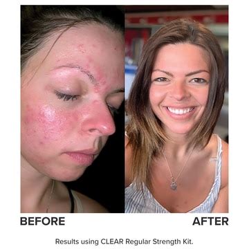 CLEAR Daily Skin Clearing Treatment | 2.5% Benzoyl Peroxide | Paula's ...