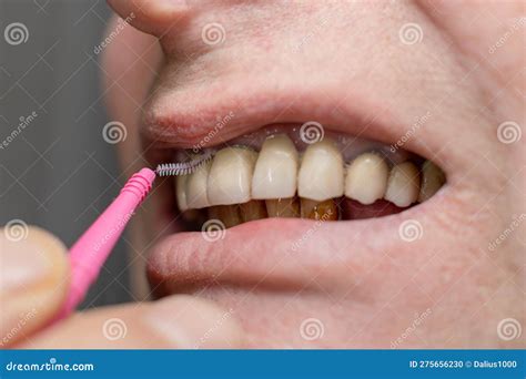 Image result for How to Clean Front Teeth Partials