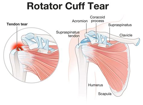 Rotator Cuff Tear Treatment & Exercises - IMPACT Physical Therapy