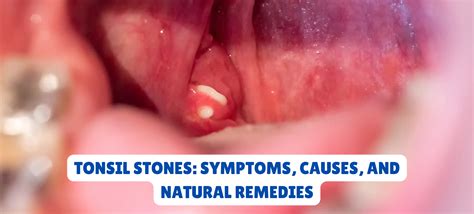 Coughing Up Tonsil Stones