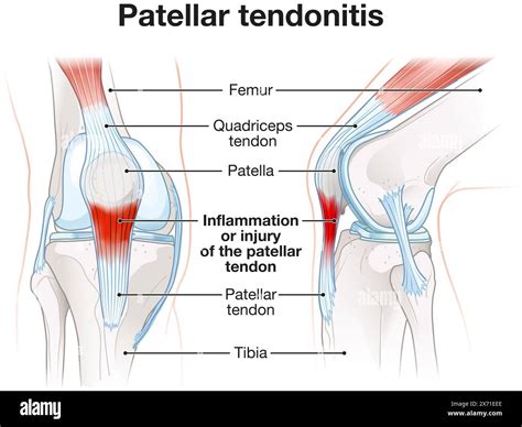 Patellar Tendonitis Selfcare
