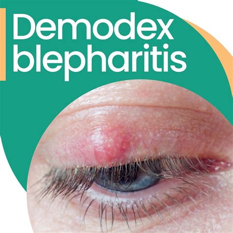 Blepharitis and demodex mites – Artofit