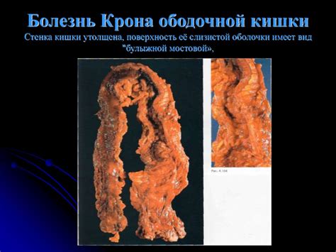Болезнь Крона: причины, симптомы, диагностика и лечение