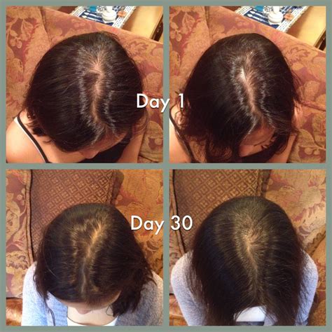 Does Rogaine or Monoxidil really work for thinning hair? | How to regrow your hair