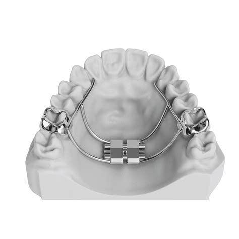 Palatal Expansion | ODL Orthodontic Labs