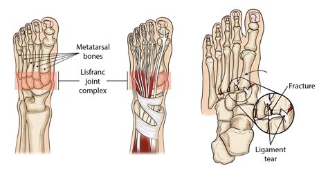 What Is A Lisfranc Injury