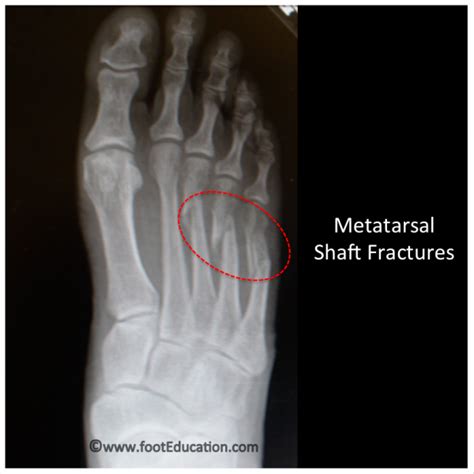 Metatarsal Shaft Fractures - FootEducation