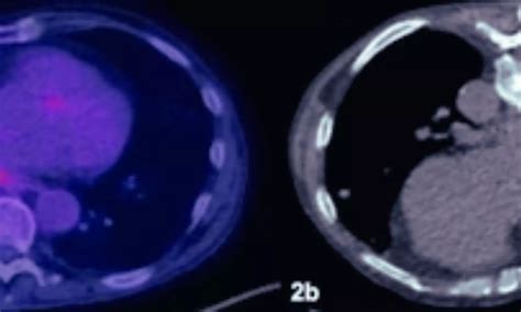 Repeat CT-guided biopsy Ok, trial does not support PET-CT in diagnostic ...
