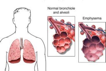 Image result for Emphysema Example