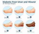Diabetic Foot Ulcer Care Plan at Rodney Eubanks blog