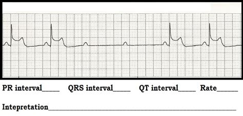 Image result for Synchronized Cardioversion EKG Strips Practice