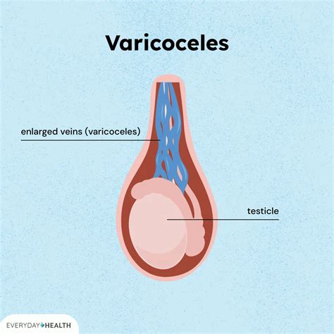Varicocele Symptoms, Causes, Diagnosis, Treatment, Prevention