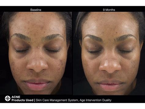 Jan Marini Skin Research Age Intervention Duality MD | LovelySkin