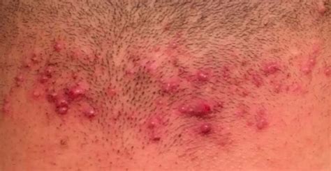 Foliculitis, una indicación para el tratamiento de depilación láser ...