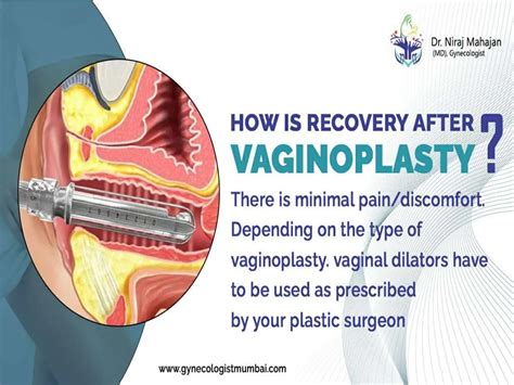 What Is Vaginoplasty