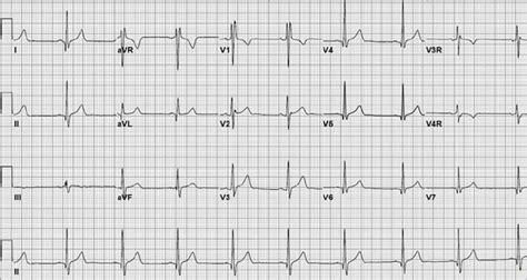 Image result for ASD Extension