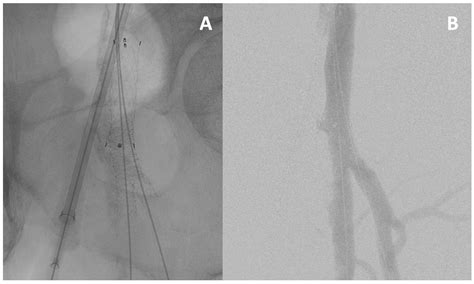 Percutaneous Endovascular Reconstruction of the Common Femoral Artery ...