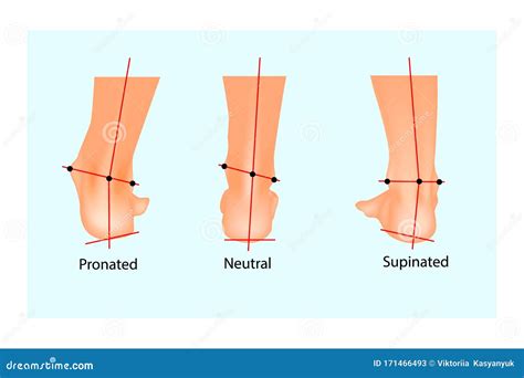 Vector Illustration of the Normal Human Foot and the Foot with Pronation and Supination. Stock ...