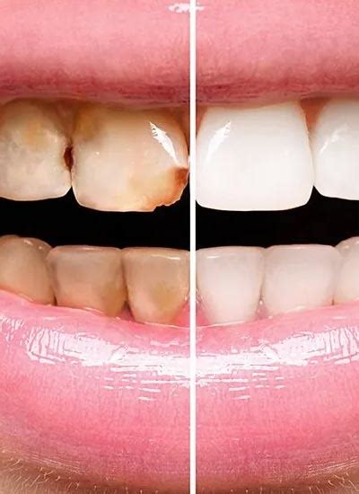 Ethos Dental Clinic , Narsingi, Bhimavaram, Visakhapatnam and Mancherial