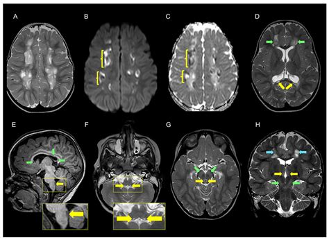 Biallelic NDUFA4 Deletion Causes Mitochondrial Complex IV Deficiency in ...