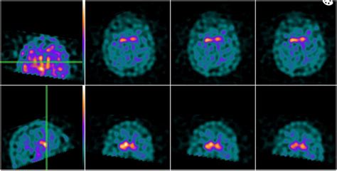 Image result for Normal DaTscan