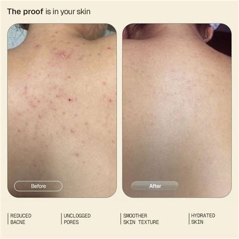 ARATA 1% Salicylic Acid Daily Body Wash | Reduces Bacne and strawberry ...
