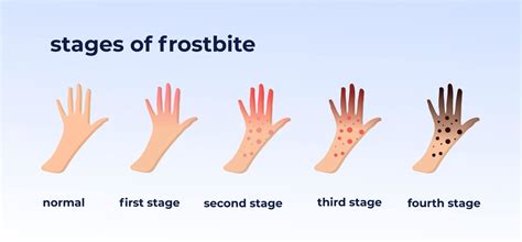 Image result for Propane Tank Exploded