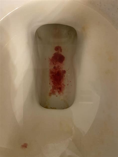 Hemorrhoids Bleeding In Toilet