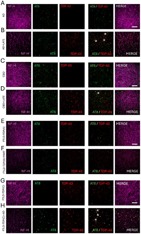 Looking into Abnormal Co-Expressions of Tau and TDP-43 in the Realm of ...