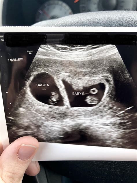 Twins 8 week ultrasound – Artofit
