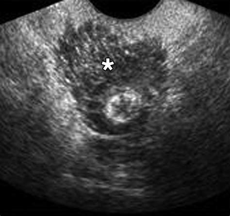 Endometriosis of the Posterior Cul-De-Sac: Clinical Presentation and ...