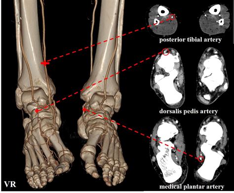 Improved small vessel visibility in diabetic foot arteriography using dual-energy CT - Clinical ...