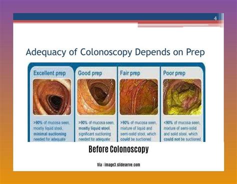 Image result for Before Colonoscopy Procedure