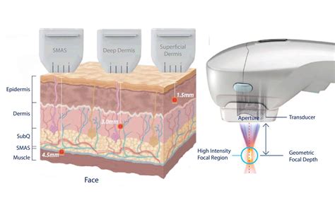 HIFU Face Lift Treatment Singapore | Dream Plastic Surgery