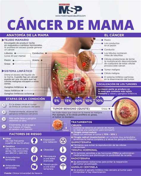 Cáncer de seno - Infografía