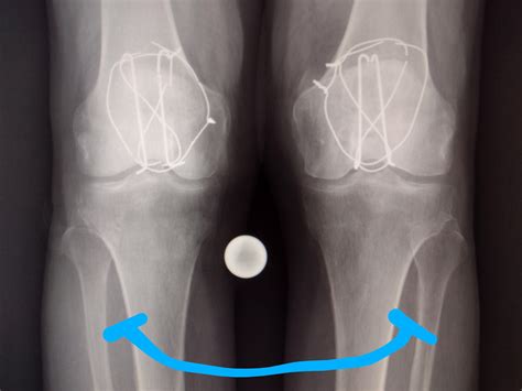 hand with mirror-hand syndrome : r/XRayPorn