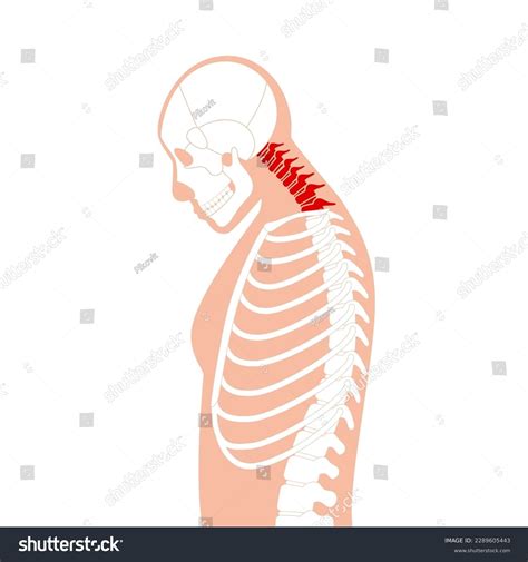 Diagram Deformation Cervical Vertebrae Neck Spasm Stock Vector (Royalty Free) 2289605443 ...
