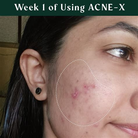 Acne Spot Treatment with Benzoyl Peroxide for Overnight Pimple Calming ...