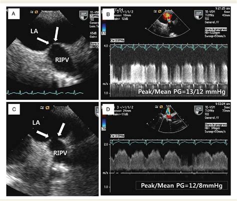 Figure 4 from Congenital pulmonary vein stenosis in an adult patient ...