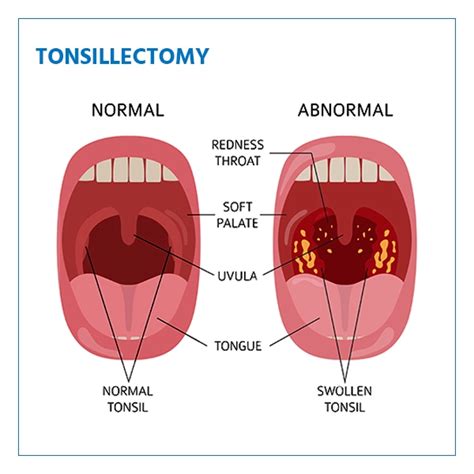 Tonsillectomy: Indications, Procedure and Recovery