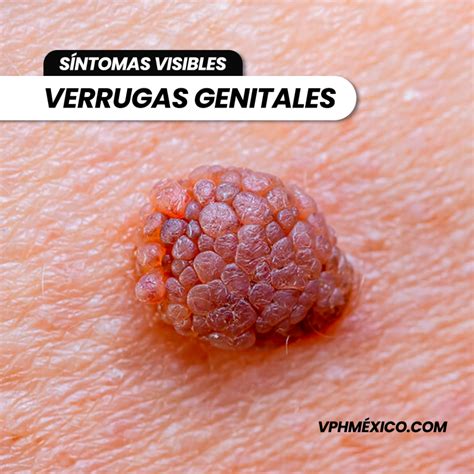 VPH en México: Síntomas, Prevención y Tratamiento - VPH EN MÉXICO