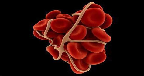 Blood poisoning ups blood clots risk | TheHealthSite.com