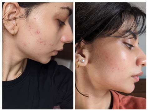 Update: so I had to stop using adapalene and added benzoyl peroxide in my routine instead... I ...