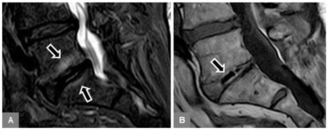 Vertebral Bone Marrow and Endplate Assessment on MR Imaging for the Differentiation of Modic ...