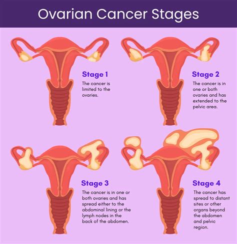 Stage 4 Ovarian Cancer: Prognosis, Survival Rate, Life Expectancy, Cure